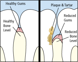 Gum Disease at Nina Kiani, DDS