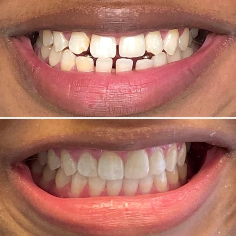 BRIANNE BEFORE AFTER INVISALIGN