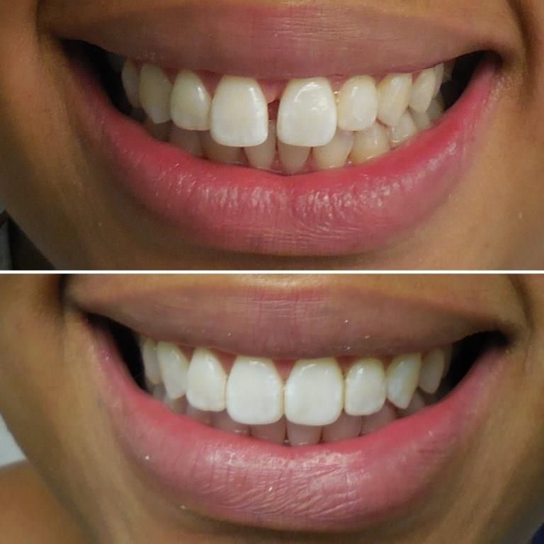 ASHLEY BEFORE AFTER INVISALIGN